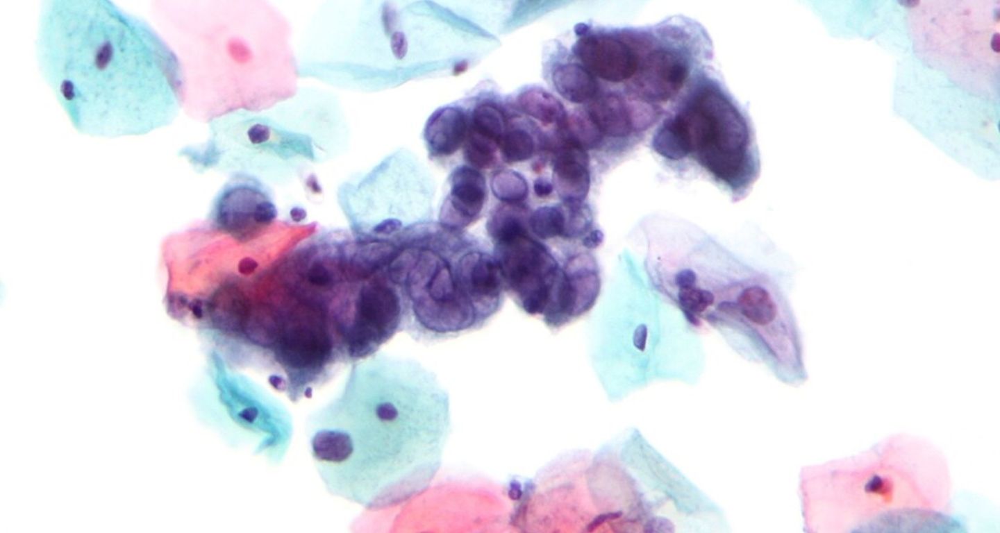 Micrografía que muestra los cambios del virus del herpes simple. [Foto: Nephron/Wikimedia Commons]