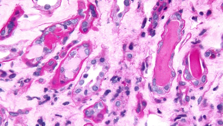 Micrografía que muestra nefropatía por cilindros de mieloma en una biopsia renal. [Foto: Freepik]

